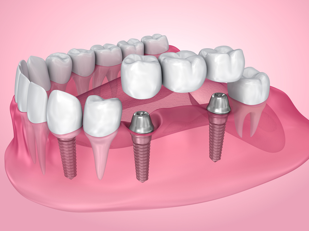 dental implants procedure