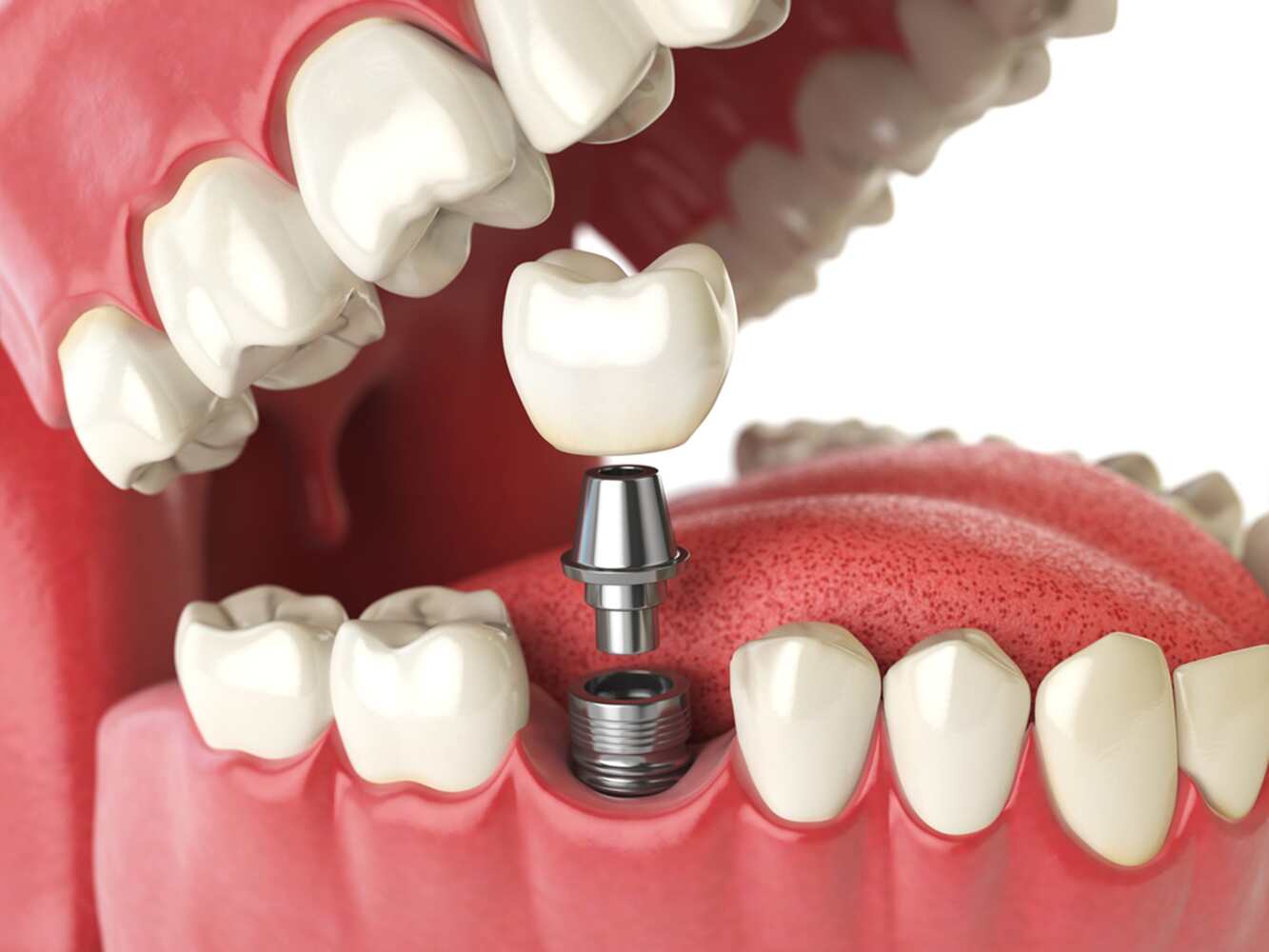 importance of dental implants in modern dentistry