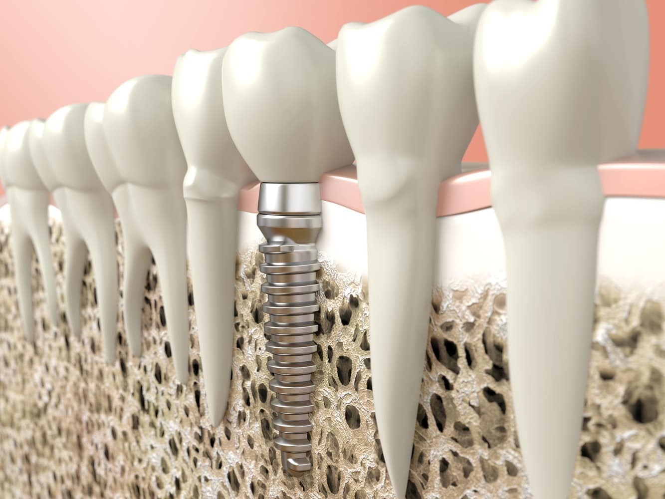 can implants replace teeth lost years ago
