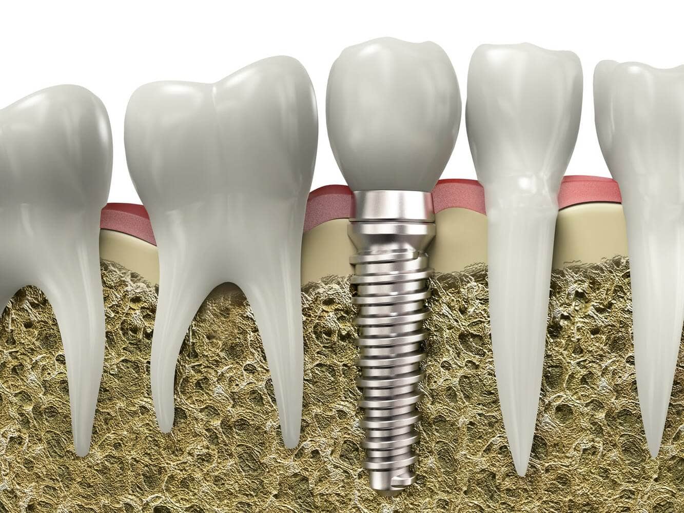 who are the right candidates for dental implants