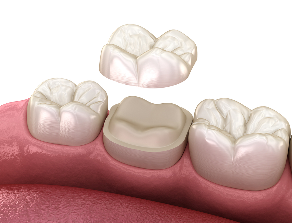 the versatility of dental inlays and onlays more than just fillings