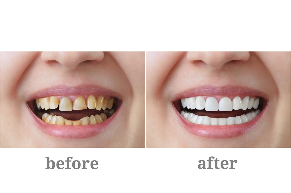 Dental Crowns in Sherwood Park, AB